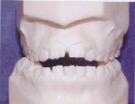 Openbite - Occlusion - Orthodontist in Glastonbury, CT