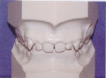 Overbite - Occlusion - Orthodontist in Glastonbury, CT