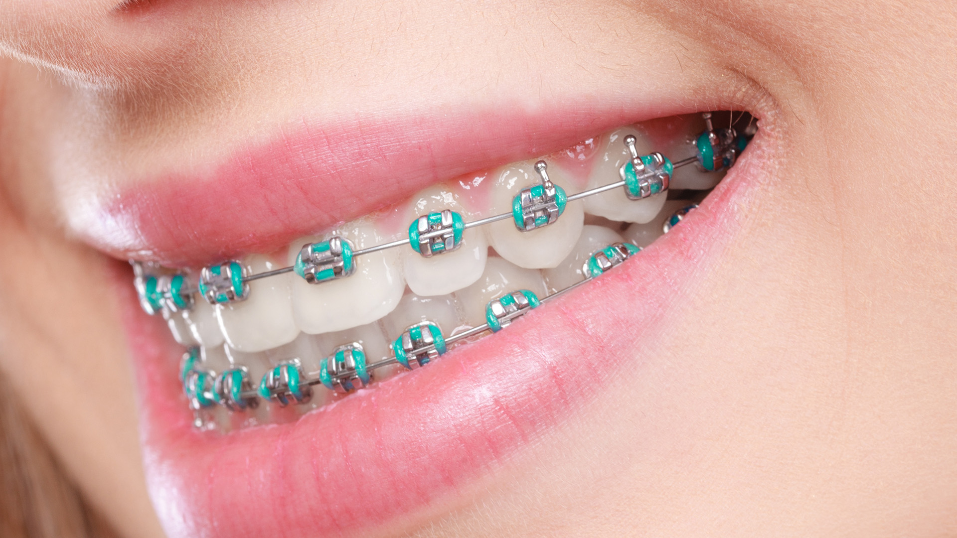 Glastonbury Orthodontics | Invisalign reg , Braces and Pediatric Orthodontics