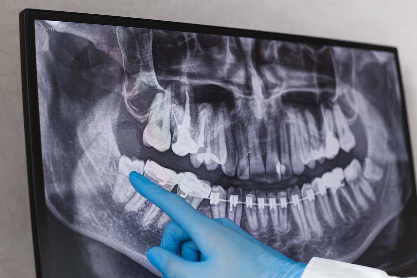 Glastonbury Orthodontics | Orthodontic Appliances, Two Phase Orthodontic Treatment and Orthognathic Surgery